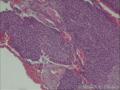 膀胱赘生物，移行细胞癌2级？图6