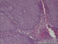 膀胱赘生物，移行细胞癌2级？图4