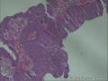 膀胱赘生物，移行细胞癌2级？图9