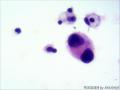胸水脱落细胞图18