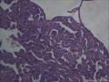 甲状腺组织，直径0.5CM,微小癌？图3