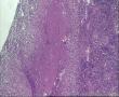 请老师看看颈部肿物，无朗汉斯巨细胞能诊断结核吗？图3