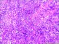 皮肤包块，纤维组织细胞瘤？图11