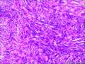 皮肤包块，纤维组织细胞瘤？图10