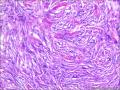 皮肤包块，纤维组织细胞瘤？图12