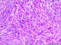 皮肤包块，纤维组织细胞瘤？图3