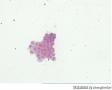 胸水   癌细胞图12