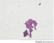 胸水   癌细胞图7