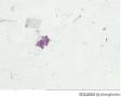 胸水   癌细胞图17