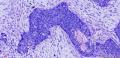 粘膜下子宫肌瘤图10