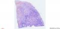 粘膜下子宫肌瘤图2