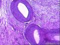 卵巢囊性肿物图5