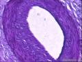卵巢囊性肿物图9