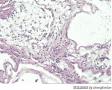 子宫肌层腺癌图7