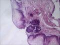 膀胱粘膜，可以发腺性膀胱炎吗/图4