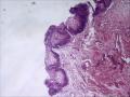 膀胱粘膜，可以发腺性膀胱炎吗/图3