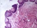 膀胱粘膜，可以发腺性膀胱炎吗/图2
