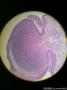球结膜肿物图1