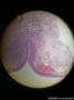 球结膜肿物图3