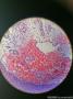 球结膜肿物图19