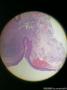 球结膜肿物图2
