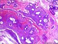 子宫内膜单纯性增生？图12至16一些扩张腺腔里是什么东西？图6