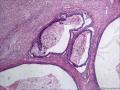 剖宫产术后卵巢图3