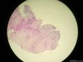 食管粘膜活检图13