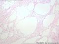 卵巢囊肿--囊性成熟型畸胎瘤图6