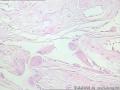 卵巢囊肿--囊性成熟型畸胎瘤图9
