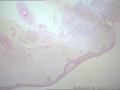 卵巢囊肿--囊性成熟型畸胎瘤图1
