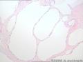卵巢囊肿--囊性成熟型畸胎瘤图5