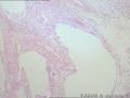 卵巢囊肿--囊性成熟型畸胎瘤图7