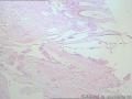 卵巢囊肿--囊性成熟型畸胎瘤图8