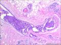 乳腺包块：普通型导管增生？导管内乳头状瘤？图8