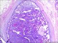 乳腺包块：普通型导管增生？导管内乳头状瘤？图3