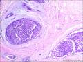 乳腺包块：普通型导管增生？导管内乳头状瘤？图11
