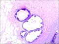 乳腺包块：普通型导管增生？导管内乳头状瘤？图7