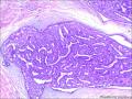 乳腺包块：普通型导管增生？导管内乳头状瘤？图1