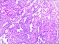 乳腺包块：普通型导管增生？导管内乳头状瘤？图15