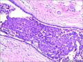 乳腺包块：普通型导管增生？导管内乳头状瘤？图12