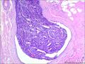 乳腺包块：普通型导管增生？导管内乳头状瘤？图4