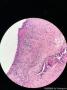 左输尿管新生物图8