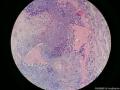 毛母质瘤，分裂象多图4