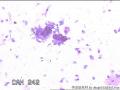 请大神看看这些细胞    患者HPV分型是阴性图25