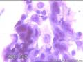 请大神看看这些细胞    患者HPV分型是阴性图24