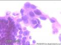 请大神看看这些细胞    患者HPV分型是阴性图3