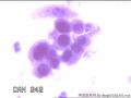 请大神看看这些细胞    患者HPV分型是阴性图17