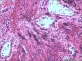 宫颈赘生物，是报血管瘤还是报血管样息肉图2