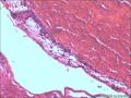 宫颈赘生物，是报血管瘤还是报血管样息肉图12